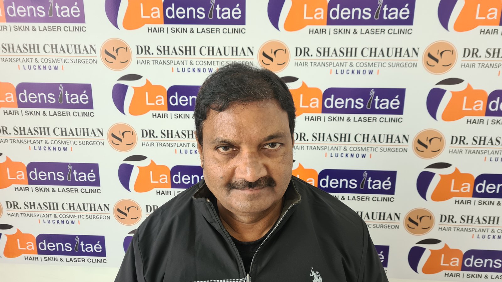 AK Singh After Hair Transplant